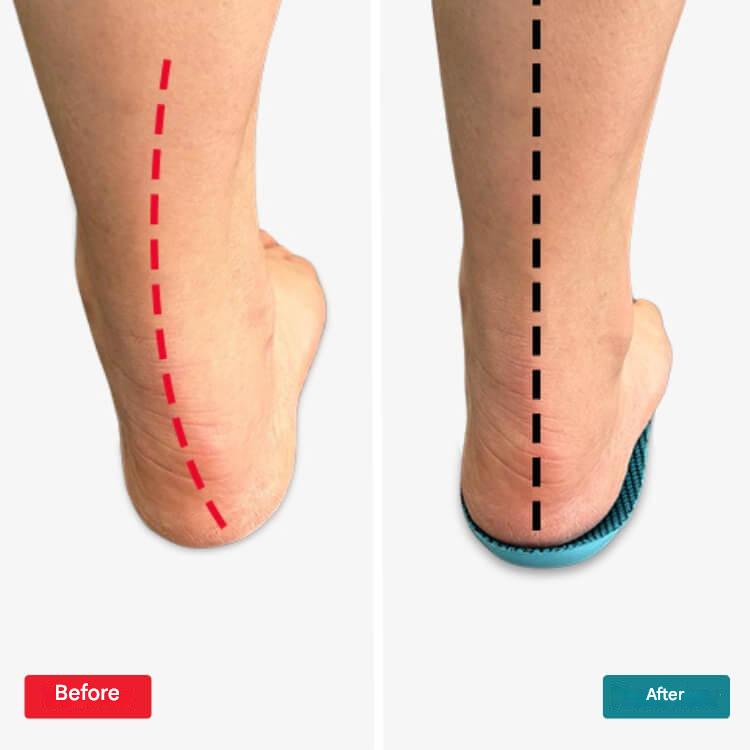Advanced orthopedic insoles with arch support for lasting comfort, ideal for daily wear & foot pain relief.